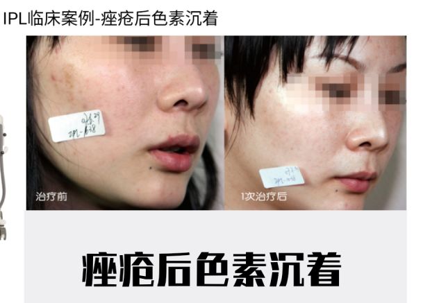 哪种医美项目祛痘印最有效,最有效的医美抗衰项目