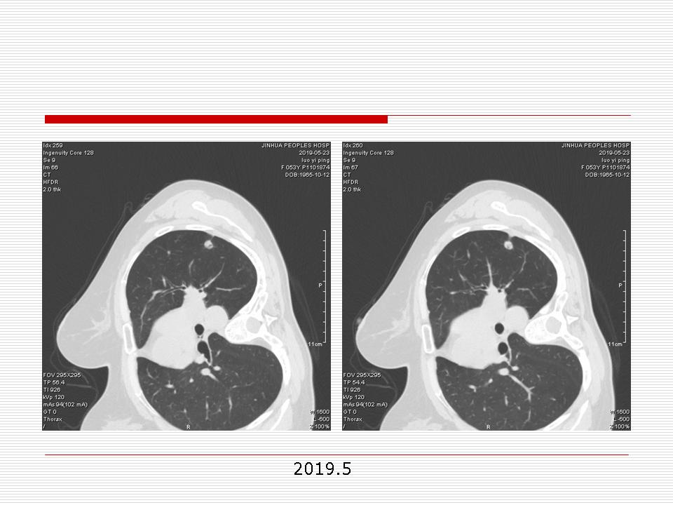 像炎症的肺癌能治好吗,医生说可能是肺癌也可能是炎症