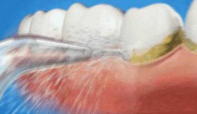 牙龈萎缩是怎么回事如何预防,预防牙龈萎缩吃什么维生素