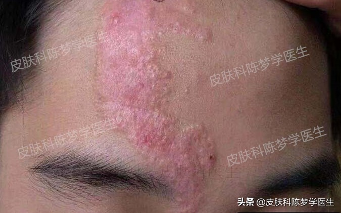 如何治疗脸上褐青色痣样斑,什么是褐青痣斑