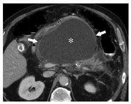 急性胰腺炎影像检查首选,急性坏死胰腺炎影像