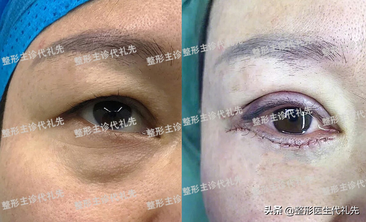 眼袋遗传的原因,眼袋大最简单手术去眼袋的方法