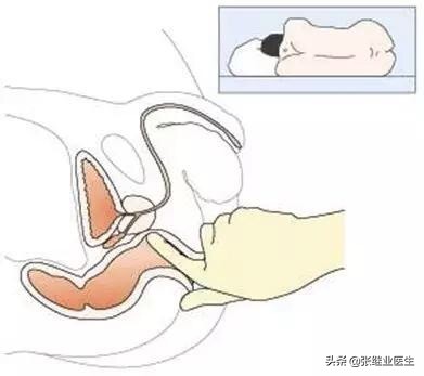 如何诊断大肠癌,大肠癌最佳检查方法