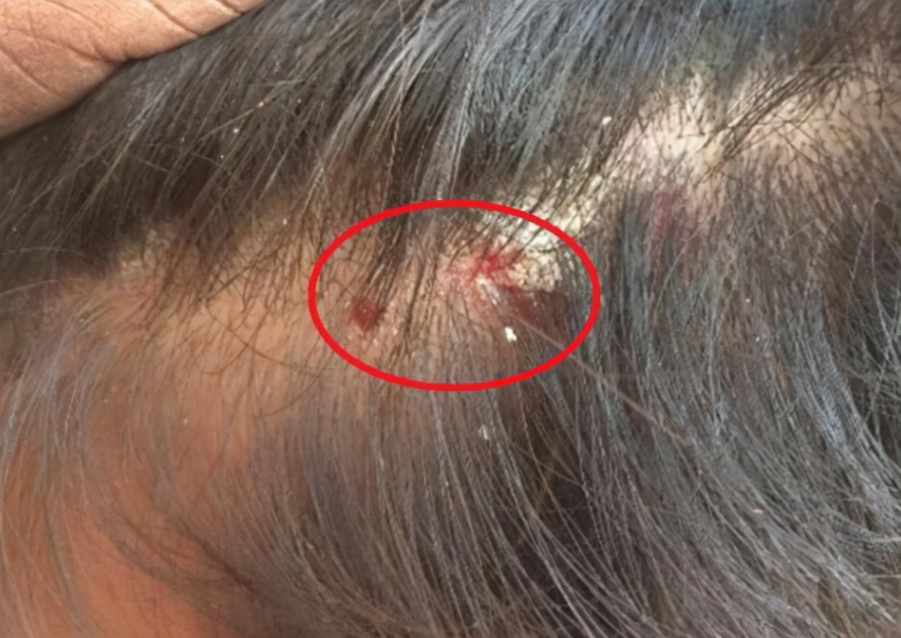 头皮和脸上起疙瘩有脓包怎么回事,头皮上总出油长有疙瘩或脓包