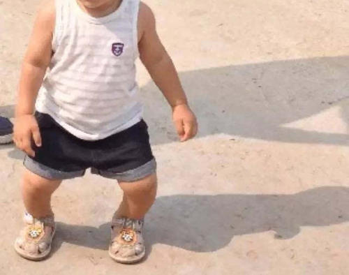 小孩是o型腿图片,孩子x型腿很严重应该怎么解决