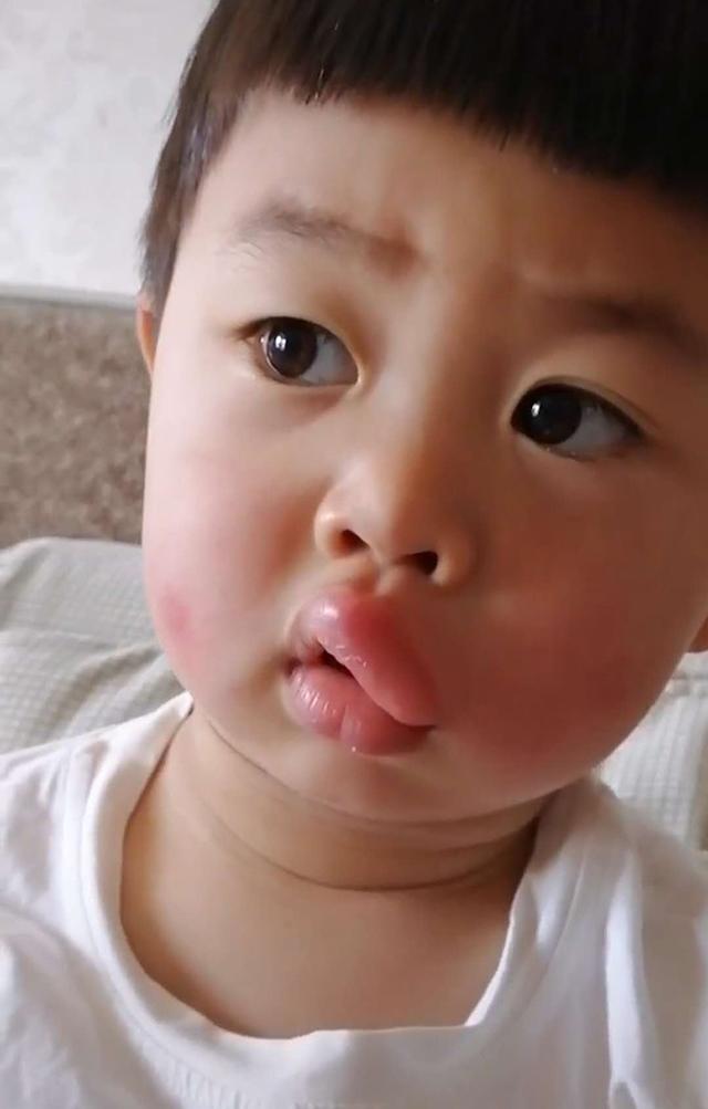 男童被蚊子咬后变成香肠嘴,小孩嘴巴被蚊子亲成香肠怎么办