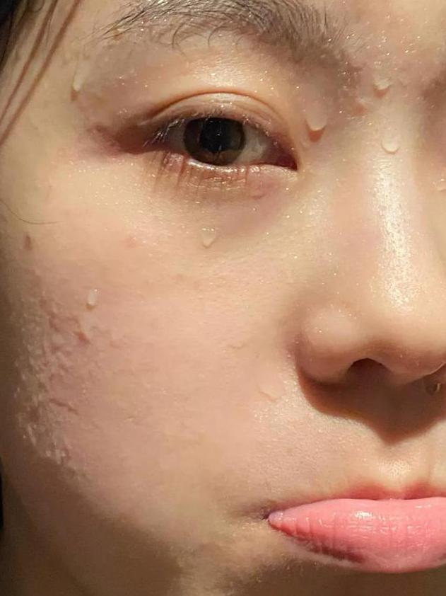 痘痘好多了脸一直红,痘痘反复没完没了