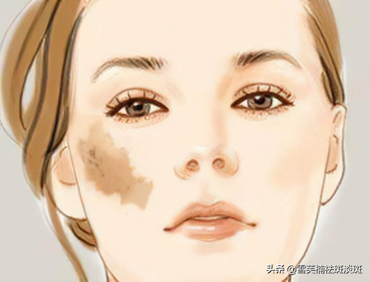 去斑点淡斑最有效方法,去斑点的最好方法最快最有效果