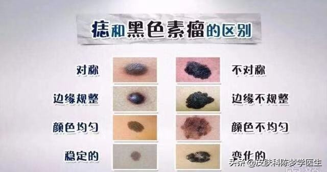一次激光点痣会导致癌变吗,激光点痣会诱发痣癌变是真的吗