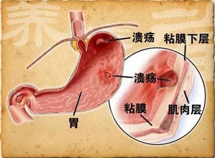 没出现胃出血应该怎么弄,怀疑是胃出血紧急处理方法