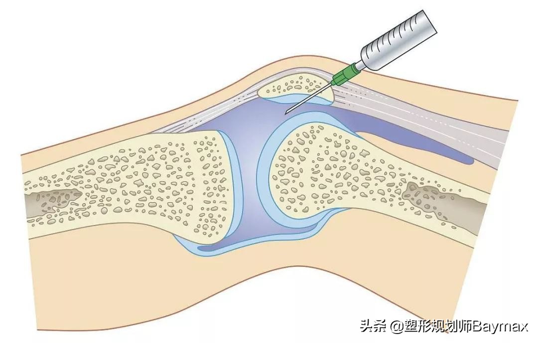 膝盖积水怎么办？不要只静养了，4个动作帮你有效缓解