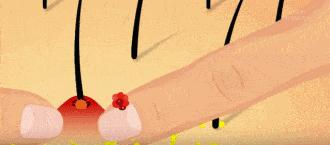 头皮毛囊炎治疗彻底根除全过程,头皮毛囊炎会导致秃头吗