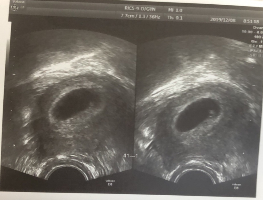 试管婴儿着床都会出血吗,试管婴儿着床后出血正常吗