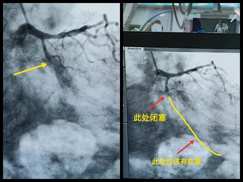 心血管严重堵塞不能放支架怎么办,心血管完全闭塞支架失败