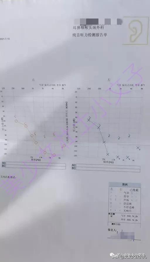 8岁孩子因急性中耳炎，导致双耳听力严重受损，重疾险顺利理赔