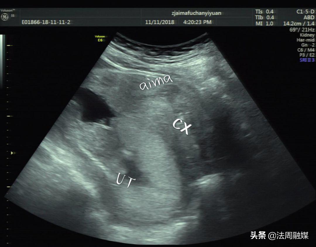 孕妇突发排尿困难，常德妇幼专家：警惕“子宫箝闭”引起的尿潴留