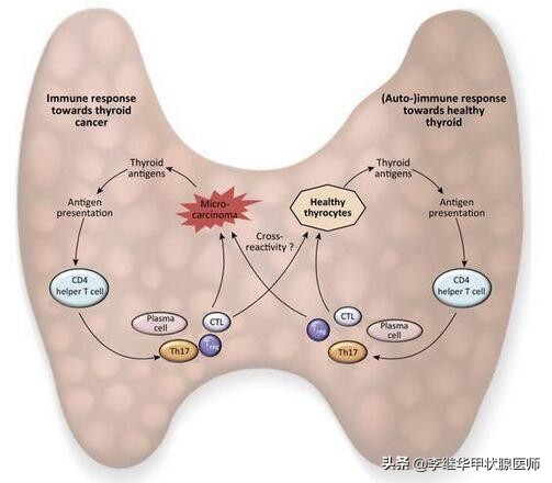 桥本氏甲减为什么医生不建议治疗,桥本氏亚甲减需要吃药吗