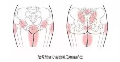 孕期耻骨痛要怎么缓解,孕期耻骨痛得很严重怎么缓解