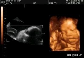 B超三维和四维彩超的区别,三维b超跟四维彩超的区别