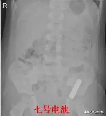 8岁男孩误吞5厘米钢钉,惊险9岁男孩误吞3厘米图钉