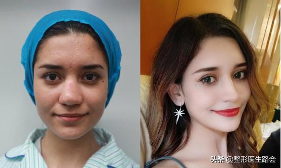 想去隆鼻,隆鼻到底值不值得入手