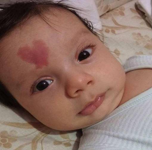 上帝吻过的脸胎记,上帝的吻痕