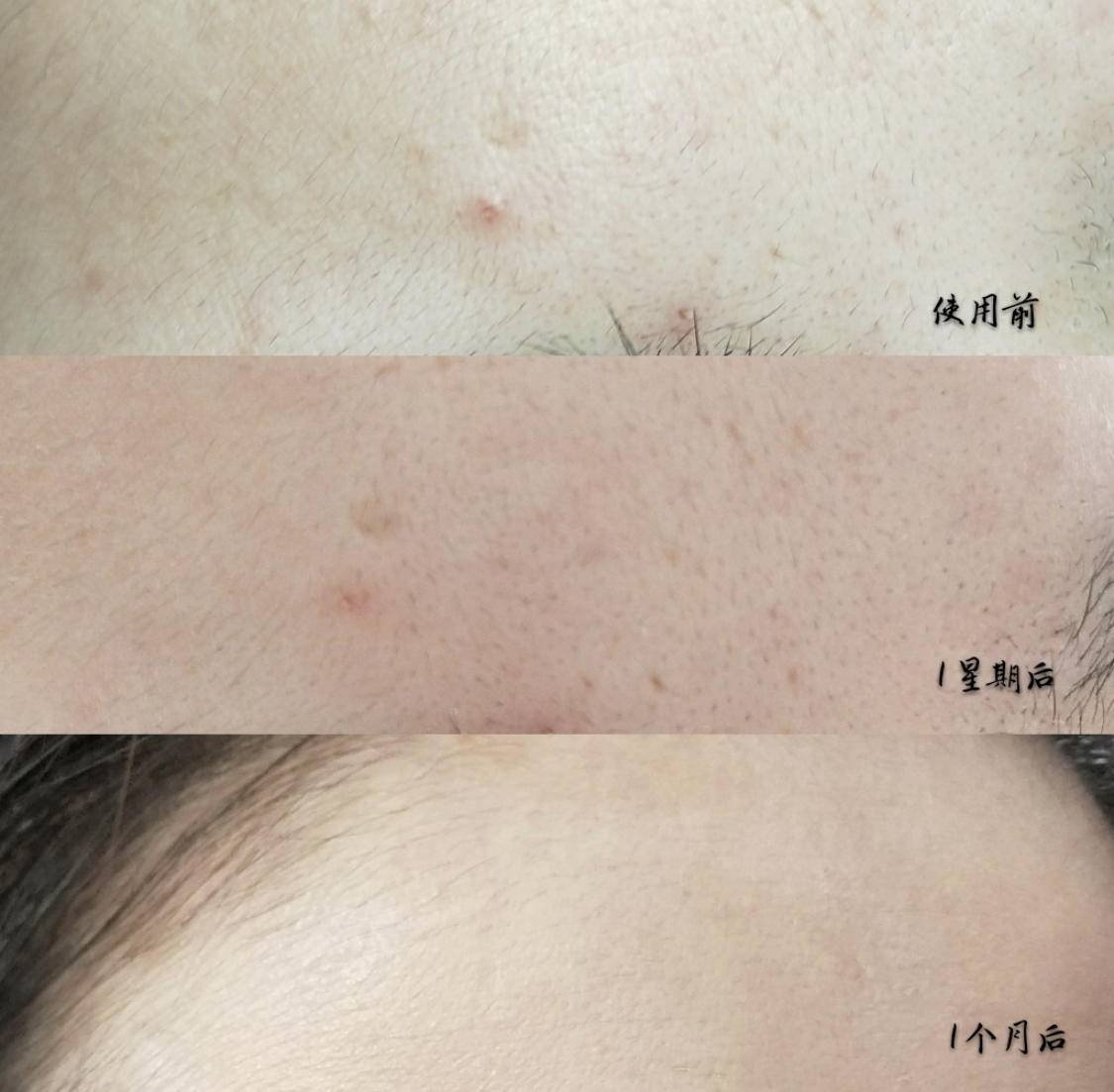 收毛孔有效的果酸产品,可以收缩毛孔的低浓度果酸