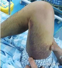 粤东蛇伤救治基地,蛇医治疗各种毒蛇咬伤