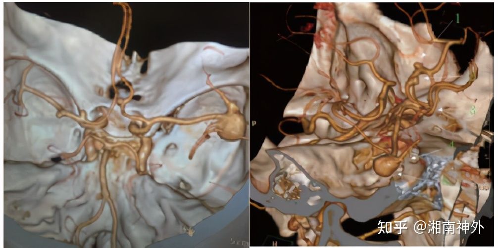 脑动脉瘤的定时炸弹,颅内定时炸弹