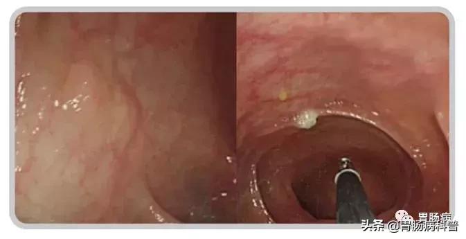 切肠息肉有风险吗,肠息肉为什么大了不能直接切