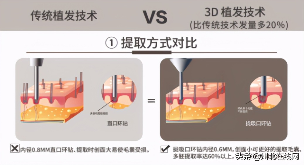 深圳新生植发治疗脱发真的有效吗,植发的危害和后遗症认准雍禾植发
