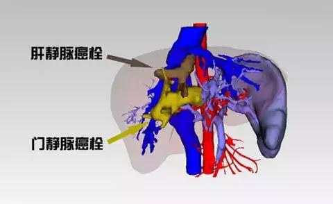 吴孟超院士团队针对肝癌合并门静脉癌栓的特色治疗