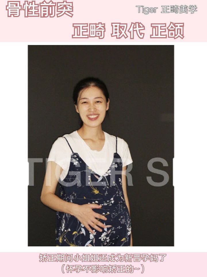 隐适美矫正危害,隐适美矫正真实案例