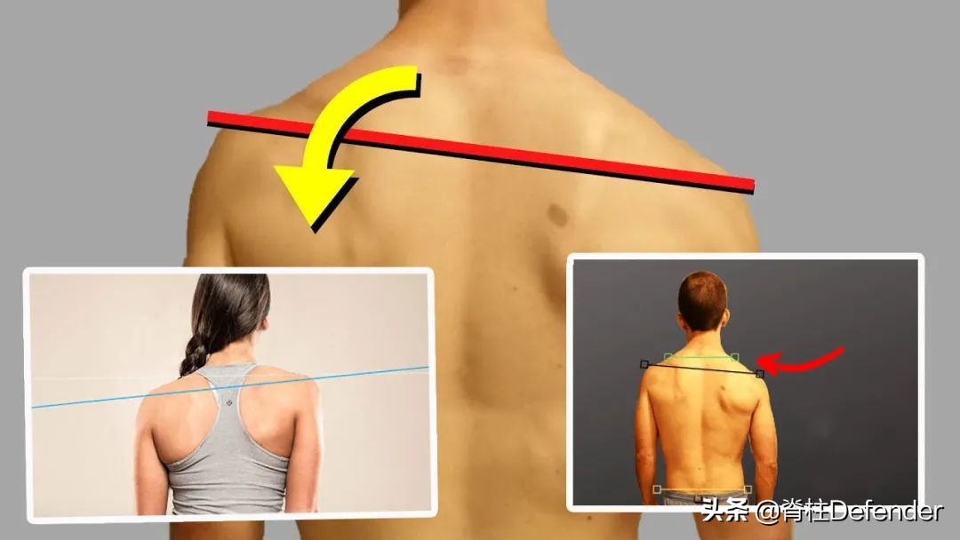 高低肩怎么健身矫正,驼背高低肩怎么矫正