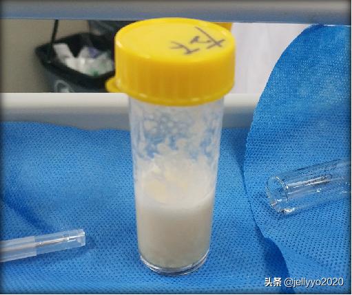 全麻支气管镜肺泡灌洗过程,支气管镜肺泡灌洗术一般做几次