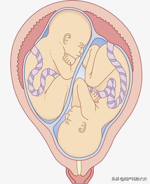 双胞胎在子宫里的发育,双胞胎在子宫里是不是两个包