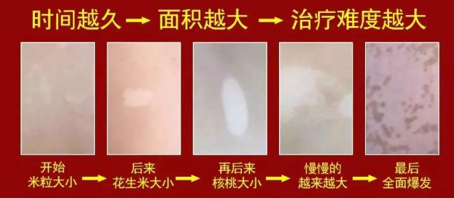 白癜风发展期怎么控制,关于白癜风的经验方