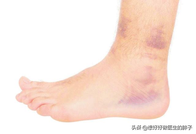 踝关节扭伤注意事项有哪些,踝关节轻微扭伤也会再次扭伤吗