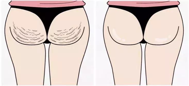 鸡皮肤留下的疤痕怎么消除,橘皮纹鸡皮肤怎么去除