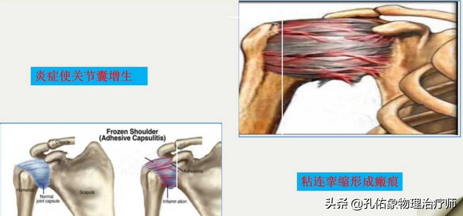 不是肩痛但肩膀很痛什么原因,不是肩周炎的疼痛