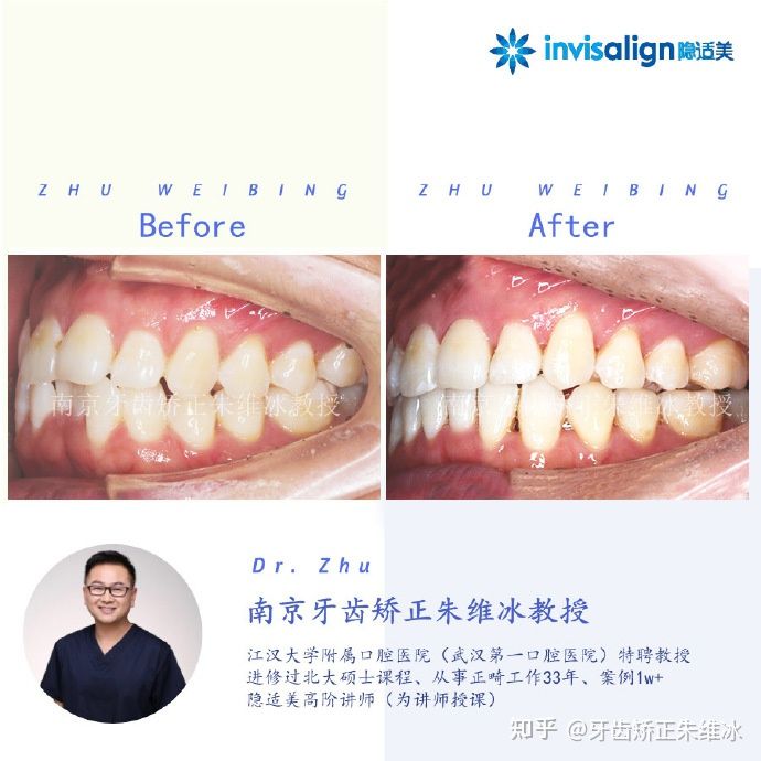 南京牙齿矫正骨性嘴凸案例,郑州牙齿矫正会让脸型更好看吗