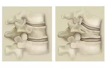胸腰椎压缩性骨折卧床怎么护理,胸腰椎压缩性骨折怎么治