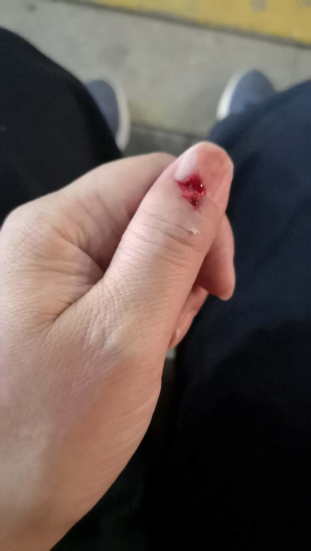 被压坏的指甲生长过程,摔倒就掉指甲是怎么回事