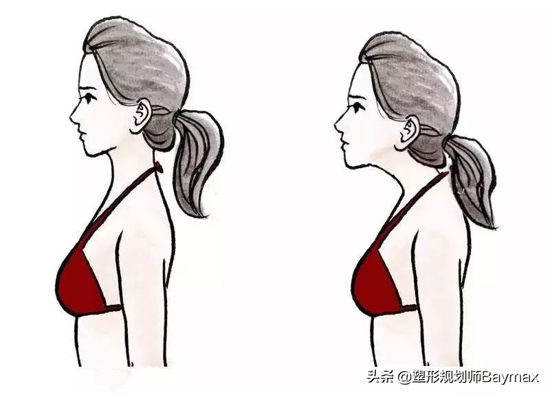 纠正颈部前伸最简单有效的方法,颈部前伸怎么办