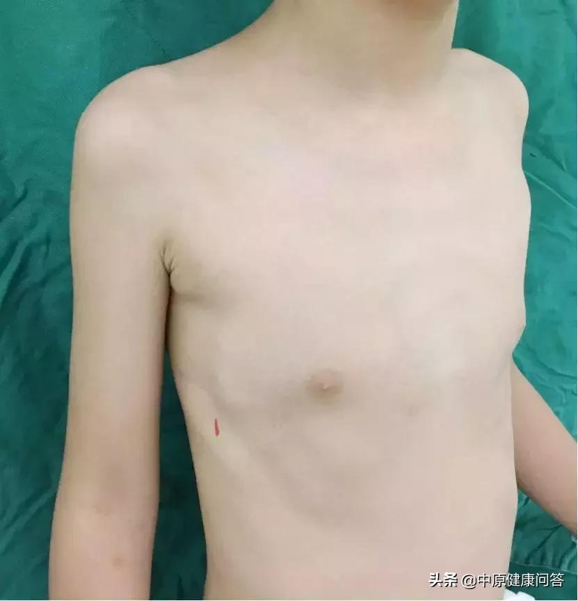 宝宝胸口凹陷地方青了,宝宝胸部凹下去一块是缺啥