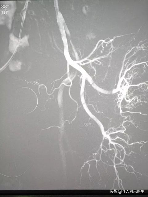 前列腺介入栓塞术和电切的区别,前列腺增生介入治疗