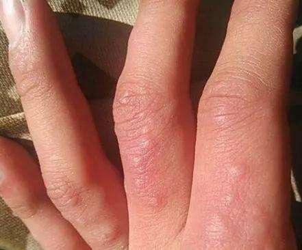 夏季手上起小水泡脱皮要怎样解决,每年夏季手上都会有小水泡