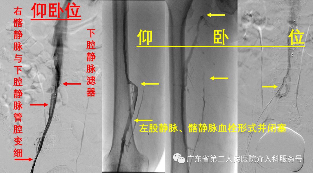 左腿血栓的最快消除方法,左腿浮肿有血栓用什么药治疗