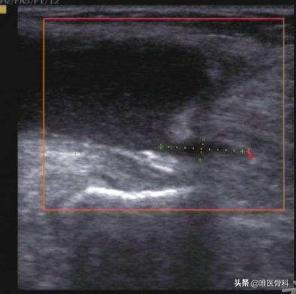 膝盖后面有个鼓鼓的包是不是病,膝盖后面有个包怎么回事