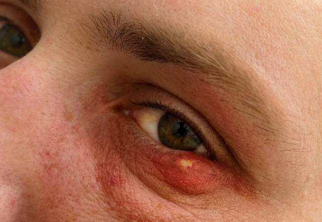 眼睛长疙瘩红肿又疼怎么办,血脂高眼睛上长疙瘩怎么办